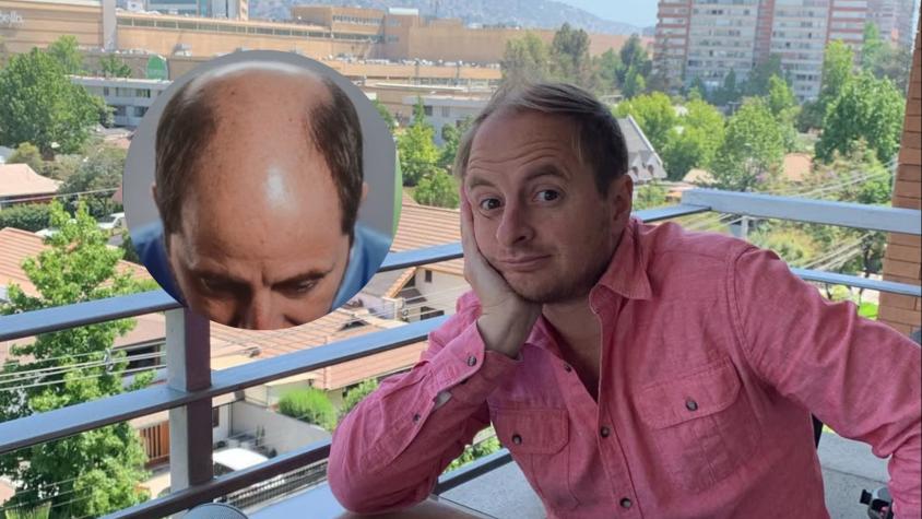 El radical cambio de Coke Hevia a un año de su injerto capilar: así luce hoy el periodista