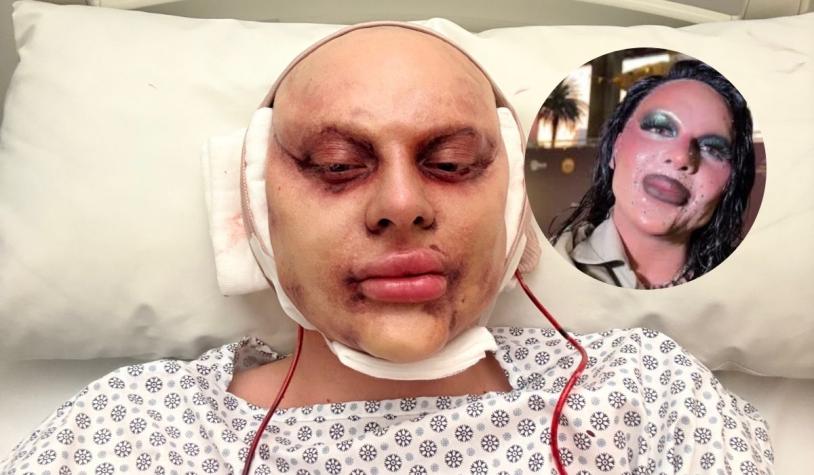 La Reina de Chile revela por qué fingió una cirugía estética: “Es un experimento social"