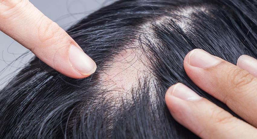 Alopecia femenina: ¿Cómo saber si la tengo y cuales son los factores de riesgo?