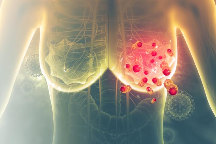 ¿Cómo identificar un cáncer de mama? Oncóloga entregó consejos 