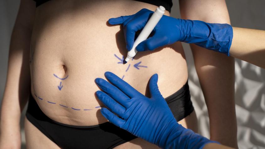 Bono PAD "guatita de delantal": este es el valor de la abdominoplastia
