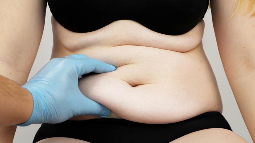 Abdominoplastía con Bono PAD: así puedes pagar solo $268.770 al momento de la cirugía